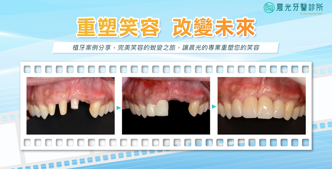 前牙植牙的精湛藝術