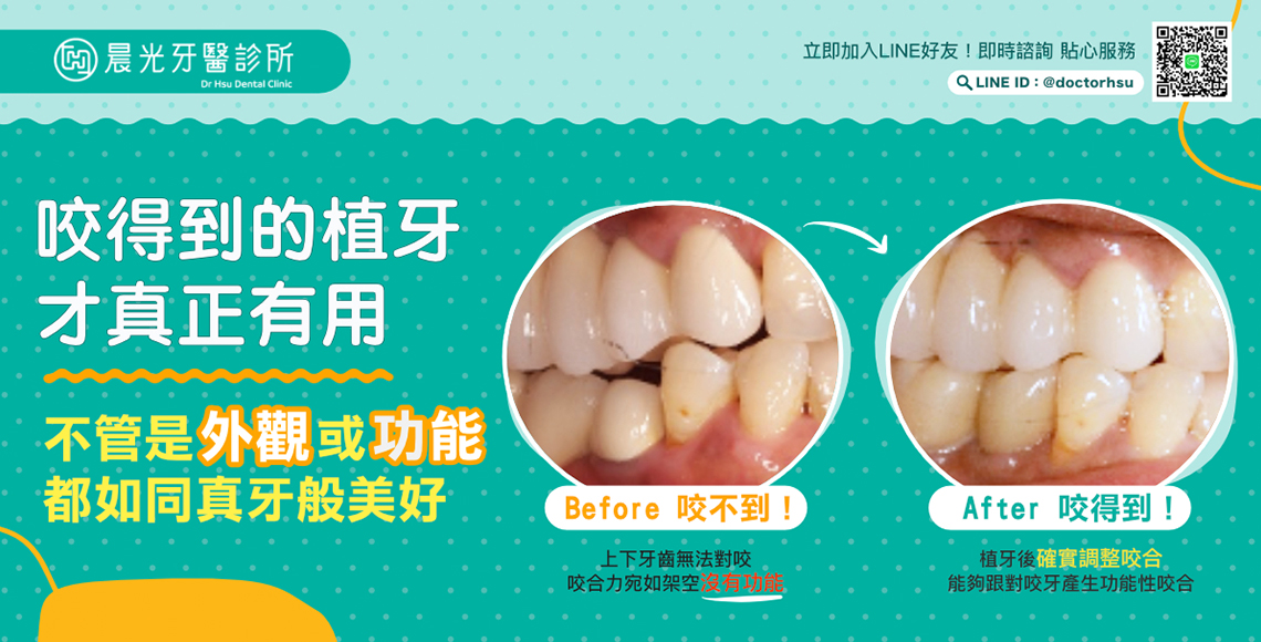 植牙咬合